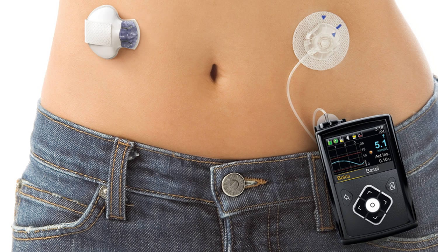 custom shaped batteries for medical devices eg insulin pump