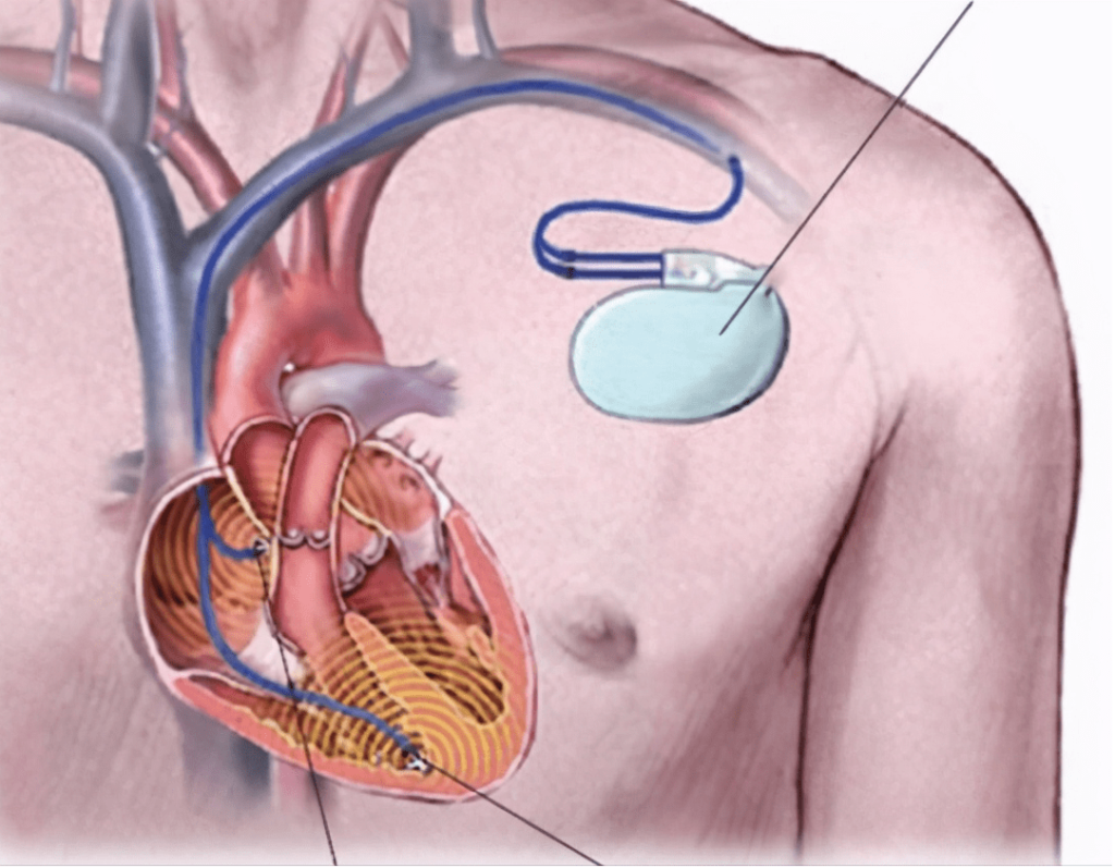 Custom-Shaped Battery for Medical Devices 1 custom-shaped batteries for medical devices-Cardiac pacemaker